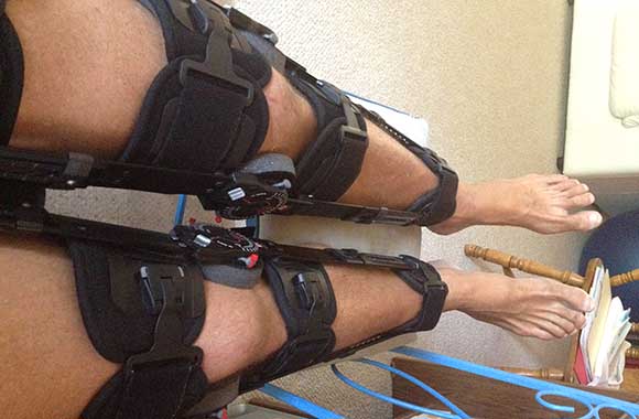 Massive Knee Surgery and Repair due to NSAIDS and ibuprofen use
